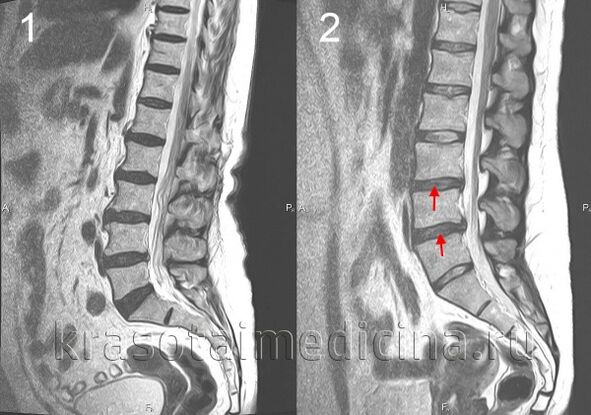 Osteocondrose da coluna
