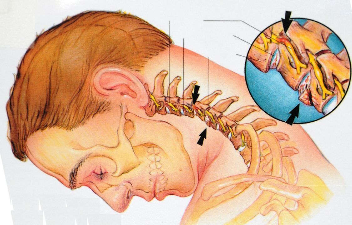 Osteocondrose da região cervical